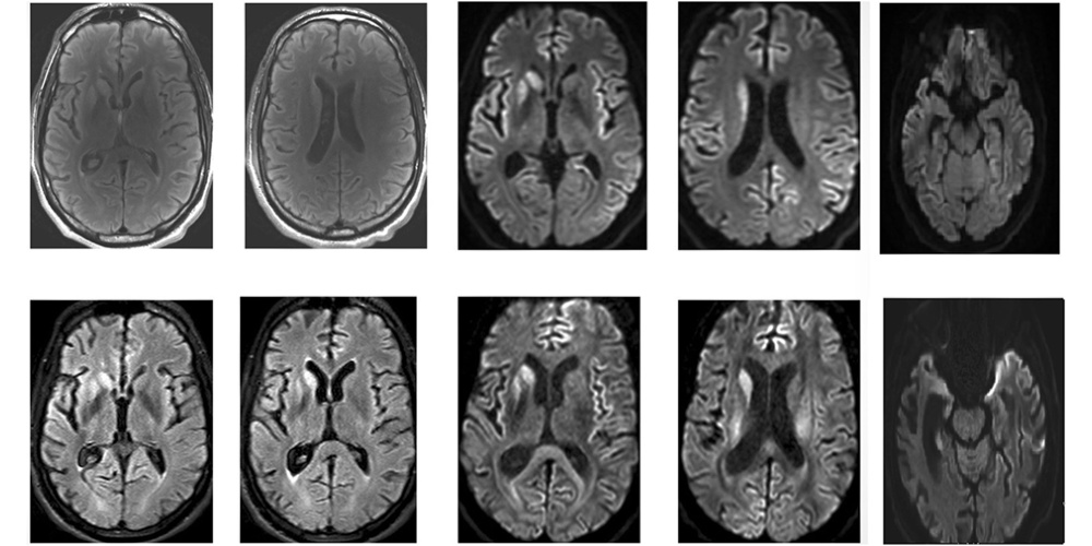 Creutzfeldt-Jakob Disease