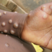 United States Confirms 2 Cases Of Monkeypox In Children