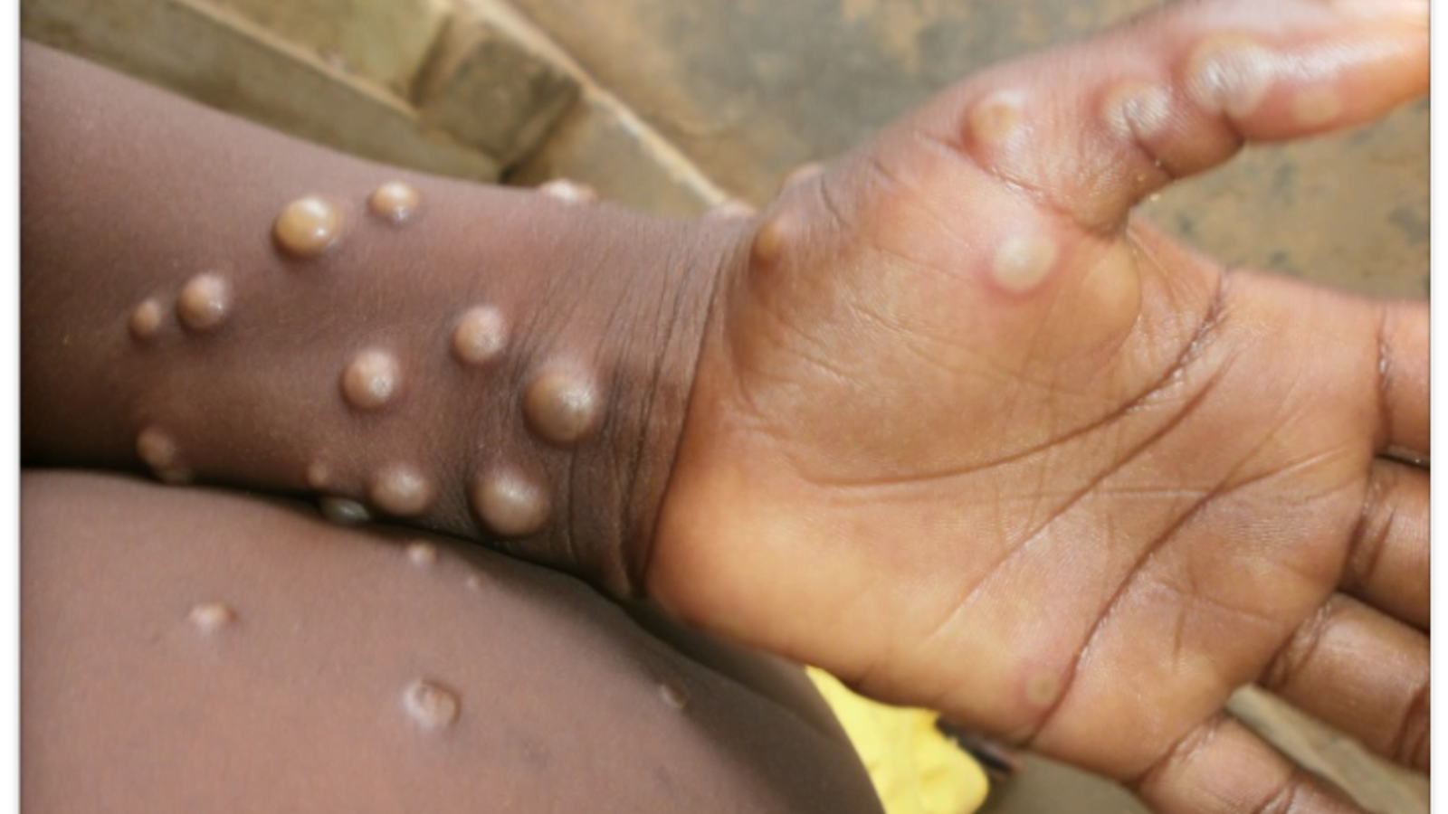 United States Confirms 2 Cases Of Monkeypox In Children