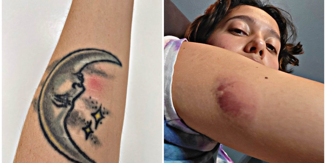 Recipients of the Monkeypox Vaccine Complain of Uncomfortable Side Effects