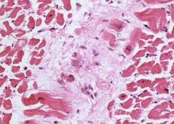 Myocarditis (2)