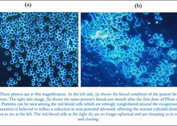 Study Using Dark-Field Microscopic Analysis Shows Abnormalities in Blood of Jabbed Patients