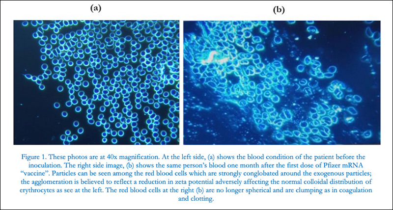 Study Using Dark-Field Microscopic Analysis Shows Abnormalities in Blood of Jabbed Patients