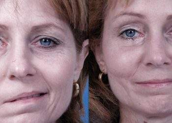 Bell's Palsy