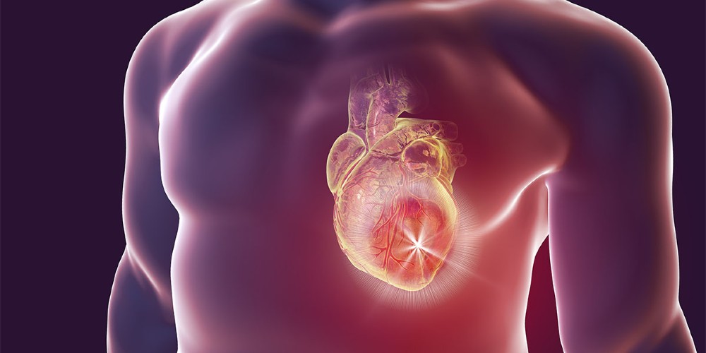 Myocarditis