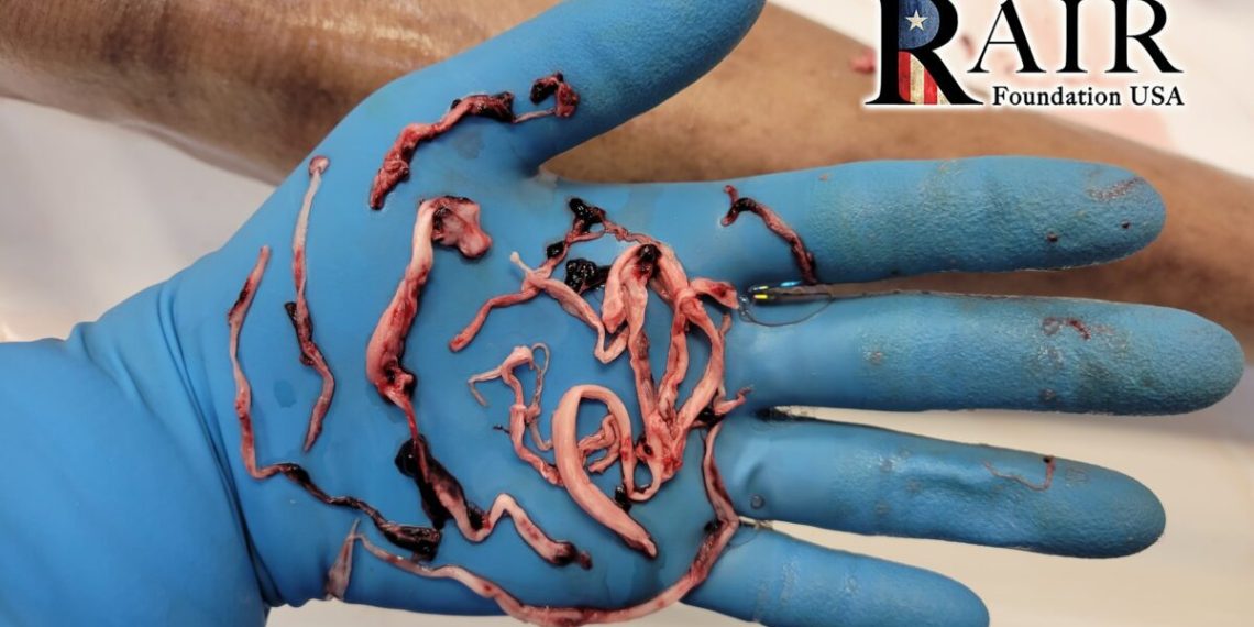 Survey of Embalmers Reveals Massive Increase in White Blood Clots Since Covid 'Vaccine' Rollout (Video)