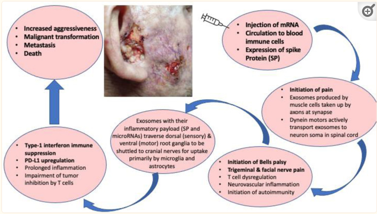 Insane & Gross Turbo Cancer Cases From Covid Shots Flooding Social Media