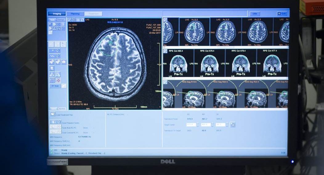Are Conservative and Liberal Brains Different? Maybe Just a Little