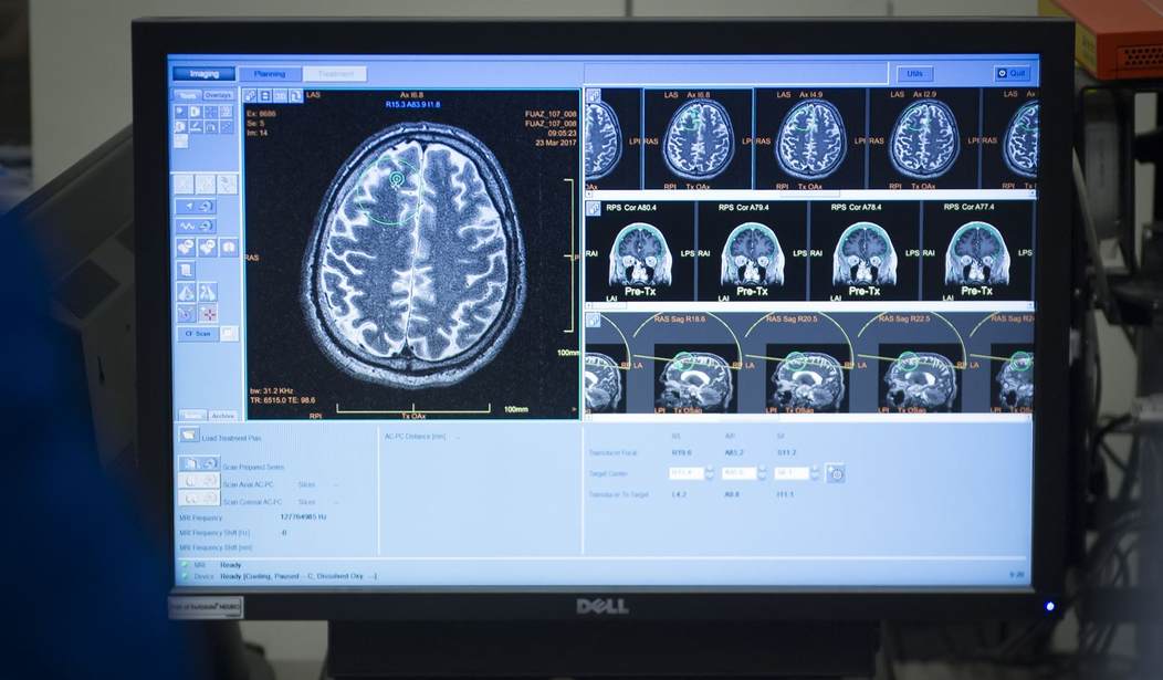 Are Conservative and Liberal Brains Different? Maybe Just a Little